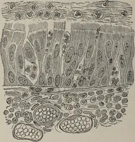 An illustration from A text-book of pathology / by Alfred Stengel ; with 394 illustrations in the text, many of them in colors, and 7 full-page chromolithographic plates. (1903)