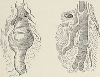 An illustration from A text-book of pathology / by Alfred Stengel ; with 394 illustrations in the text, many of them in colors, and 7 full-page chromolithographic plates. (1903)