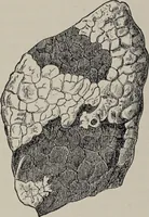 An illustration from A text-book of pathology / by Alfred Stengel ; with 394 illustrations in the text, many of them in colors, and 7 full-page chromolithographic plates. (1903)