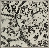Picture 107 of 178 from A text-book of pathology / by Alfred Stengel ; with 394 illustrations in the text, many of them in colors, and 7 full-page chromolithographic plates. (1903), leaf 475