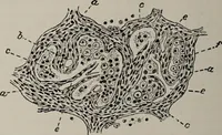 An illustration from A text-book of pathology / by Alfred Stengel ; with 394 illustrations in the text, many of them in colors, and 7 full-page chromolithographic plates. (1903)