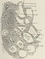 An illustration from A text-book of pathology / by Alfred Stengel ; with 394 illustrations in the text, many of them in colors, and 7 full-page chromolithographic plates. (1903)