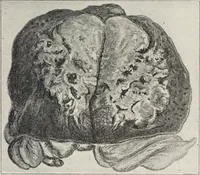 An illustration from A text-book of pathology / by Alfred Stengel ; with 394 illustrations in the text, many of them in colors, and 7 full-page chromolithographic plates. (1903)