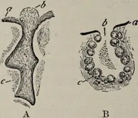 An illustration from A text-book of pathology / by Alfred Stengel ; with 394 illustrations in the text, many of them in colors, and 7 full-page chromolithographic plates. (1903)