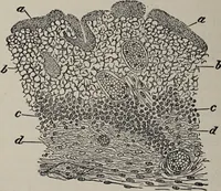 An illustration from A text-book of pathology / by Alfred Stengel ; with 394 illustrations in the text, many of them in colors, and 7 full-page chromolithographic plates. (1903)