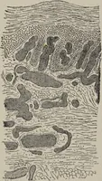 An illustration from A text-book of pathology / by Alfred Stengel ; with 394 illustrations in the text, many of them in colors, and 7 full-page chromolithographic plates. (1903)
