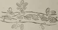 An illustration from A text-book of pathology / by Alfred Stengel ; with 394 illustrations in the text, many of them in colors, and 7 full-page chromolithographic plates. (1903)