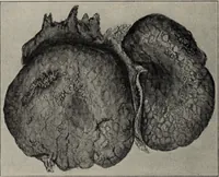 An illustration from A text-book of pathology / by Alfred Stengel ; with 394 illustrations in the text, many of them in colors, and 7 full-page chromolithographic plates. (1903)