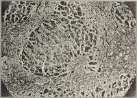 An illustration from A text-book of pathology / by Alfred Stengel ; with 394 illustrations in the text, many of them in colors, and 7 full-page chromolithographic plates. (1903)