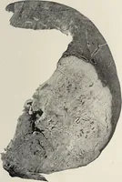 An illustration from A text-book of pathology / by Alfred Stengel ; with 394 illustrations in the text, many of them in colors, and 7 full-page chromolithographic plates. (1903)