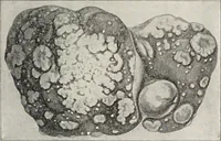 An illustration from A text-book of pathology / by Alfred Stengel ; with 394 illustrations in the text, many of them in colors, and 7 full-page chromolithographic plates. (1903)