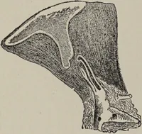 An illustration from A text-book of pathology / by Alfred Stengel ; with 394 illustrations in the text, many of them in colors, and 7 full-page chromolithographic plates. (1903)