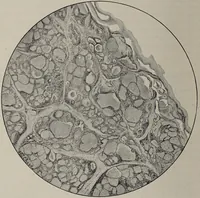 An illustration from A text-book of pathology / by Alfred Stengel ; with 394 illustrations in the text, many of them in colors, and 7 full-page chromolithographic plates. (1903)