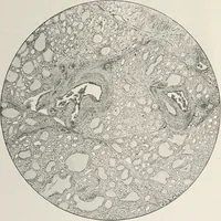 An illustration from A text-book of pathology / by Alfred Stengel ; with 394 illustrations in the text, many of them in colors, and 7 full-page chromolithographic plates. (1903)
