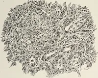 An illustration from A text-book of pathology / by Alfred Stengel ; with 394 illustrations in the text, many of them in colors, and 7 full-page chromolithographic plates. (1903)