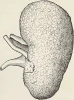 An illustration from A text-book of pathology / by Alfred Stengel ; with 394 illustrations in the text, many of them in colors, and 7 full-page chromolithographic plates. (1903)