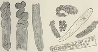 An illustration from A text-book of pathology / by Alfred Stengel ; with 394 illustrations in the text, many of them in colors, and 7 full-page chromolithographic plates. (1903)