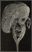 An illustration from A text-book of pathology / by Alfred Stengel ; with 394 illustrations in the text, many of them in colors, and 7 full-page chromolithographic plates. (1903)