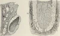 An illustration from A text-book of pathology / by Alfred Stengel ; with 394 illustrations in the text, many of them in colors, and 7 full-page chromolithographic plates. (1903)