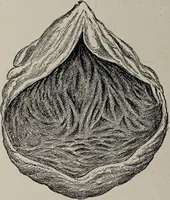 An illustration from A text-book of pathology / by Alfred Stengel ; with 394 illustrations in the text, many of them in colors, and 7 full-page chromolithographic plates. (1903)