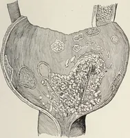 An illustration from A text-book of pathology / by Alfred Stengel ; with 394 illustrations in the text, many of them in colors, and 7 full-page chromolithographic plates. (1903)
