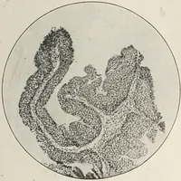 An illustration from A text-book of pathology / by Alfred Stengel ; with 394 illustrations in the text, many of them in colors, and 7 full-page chromolithographic plates. (1903)
