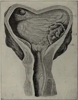 An illustration from A text-book of pathology / by Alfred Stengel ; with 394 illustrations in the text, many of them in colors, and 7 full-page chromolithographic plates. (1903)