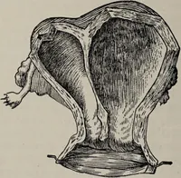 An illustration from A text-book of pathology / by Alfred Stengel ; with 394 illustrations in the text, many of them in colors, and 7 full-page chromolithographic plates. (1903)