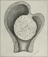 An illustration from A text-book of pathology / by Alfred Stengel ; with 394 illustrations in the text, many of them in colors, and 7 full-page chromolithographic plates. (1903)