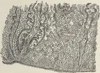 An illustration from A text-book of pathology / by Alfred Stengel ; with 394 illustrations in the text, many of them in colors, and 7 full-page chromolithographic plates. (1903)