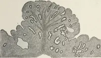 An illustration from A text-book of pathology / by Alfred Stengel ; with 394 illustrations in the text, many of them in colors, and 7 full-page chromolithographic plates. (1903)