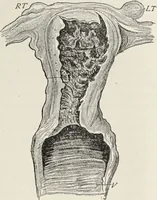 An illustration from A text-book of pathology / by Alfred Stengel ; with 394 illustrations in the text, many of them in colors, and 7 full-page chromolithographic plates. (1903)