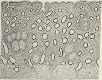 An illustration from A text-book of pathology / by Alfred Stengel ; with 394 illustrations in the text, many of them in colors, and 7 full-page chromolithographic plates. (1903)