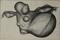 An illustration from A text-book of pathology / by Alfred Stengel ; with 394 illustrations in the text, many of them in colors, and 7 full-page chromolithographic plates. (1903)
