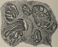 An illustration from A text-book of pathology / by Alfred Stengel ; with 394 illustrations in the text, many of them in colors, and 7 full-page chromolithographic plates. (1903)
