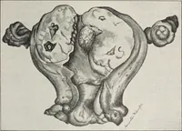Picture 149 of 178 from A text-book of pathology / by Alfred Stengel ; with 394 illustrations in the text, many of them in colors, and 7 full-page chromolithographic plates. (1903), leaf 705