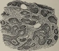 An illustration from A text-book of pathology / by Alfred Stengel ; with 394 illustrations in the text, many of them in colors, and 7 full-page chromolithographic plates. (1903)