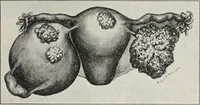 An illustration from A text-book of pathology / by Alfred Stengel ; with 394 illustrations in the text, many of them in colors, and 7 full-page chromolithographic plates. (1903)