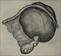 An illustration from A text-book of pathology / by Alfred Stengel ; with 394 illustrations in the text, many of them in colors, and 7 full-page chromolithographic plates. (1903)