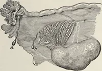 An illustration from A text-book of pathology / by Alfred Stengel ; with 394 illustrations in the text, many of them in colors, and 7 full-page chromolithographic plates. (1903)