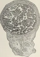 An illustration from A text-book of pathology / by Alfred Stengel ; with 394 illustrations in the text, many of them in colors, and 7 full-page chromolithographic plates. (1903)