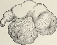 An illustration from A text-book of pathology / by Alfred Stengel ; with 394 illustrations in the text, many of them in colors, and 7 full-page chromolithographic plates. (1903)