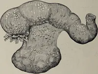 An illustration from A text-book of pathology / by Alfred Stengel ; with 394 illustrations in the text, many of them in colors, and 7 full-page chromolithographic plates. (1903)
