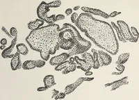 An illustration from A text-book of pathology / by Alfred Stengel ; with 394 illustrations in the text, many of them in colors, and 7 full-page chromolithographic plates. (1903)