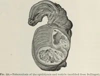 Picture 154 of 178 from A text-book of pathology / by Alfred Stengel ; with 394 illustrations in the text, many of them in colors, and 7 full-page chromolithographic plates. (1903), leaf 737