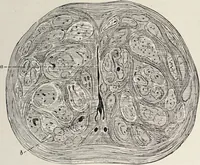 An illustration from A text-book of pathology / by Alfred Stengel ; with 394 illustrations in the text, many of them in colors, and 7 full-page chromolithographic plates. (1903)