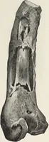 Picture 159 of 178 from A text-book of pathology / by Alfred Stengel ; with 394 illustrations in the text, many of them in colors, and 7 full-page chromolithographic plates. (1903), leaf 759