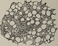 An illustration from A text-book of pathology / by Alfred Stengel ; with 394 illustrations in the text, many of them in colors, and 7 full-page chromolithographic plates. (1903)