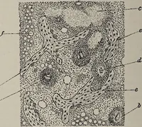 An illustration from A text-book of pathology / by Alfred Stengel ; with 394 illustrations in the text, many of them in colors, and 7 full-page chromolithographic plates. (1903)