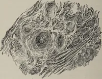 An illustration from A text-book of pathology / by Alfred Stengel ; with 394 illustrations in the text, many of them in colors, and 7 full-page chromolithographic plates. (1903)